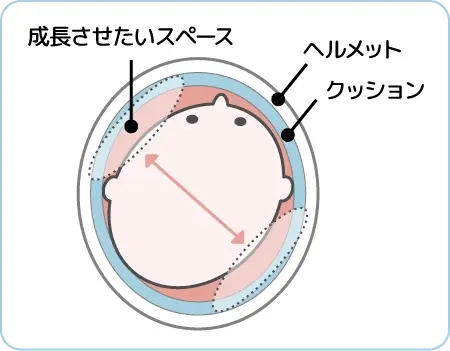 ヘルメット治療の有効性とメカニズム